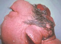 Anencephaly